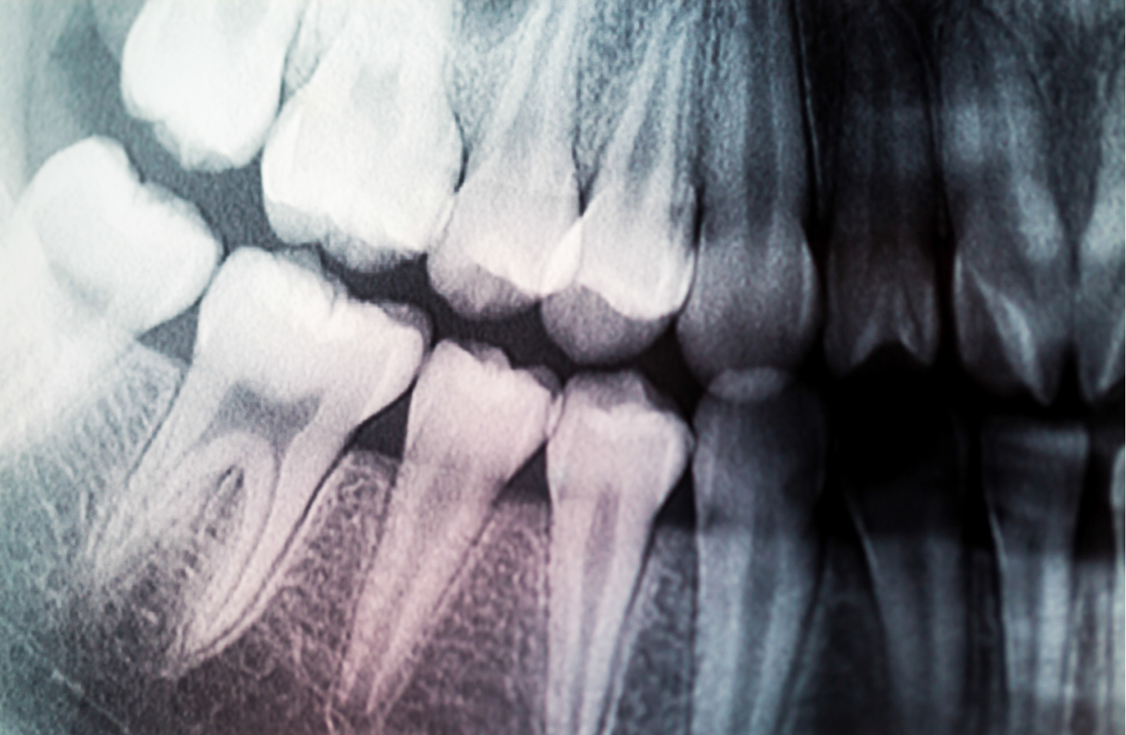 Dental X-Rays • Brad Schoonover DDS