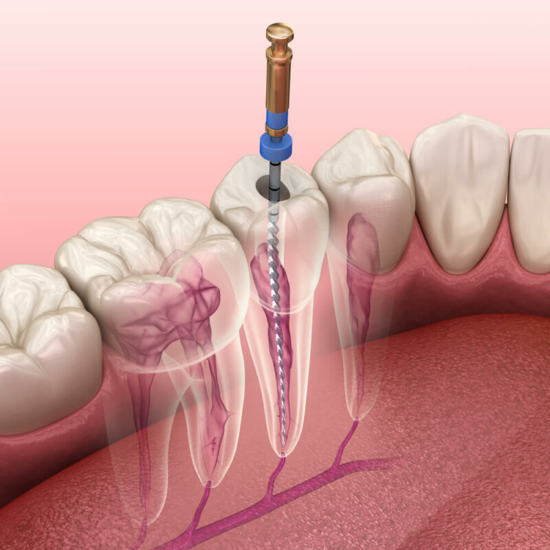 3 Root Canals In One Day